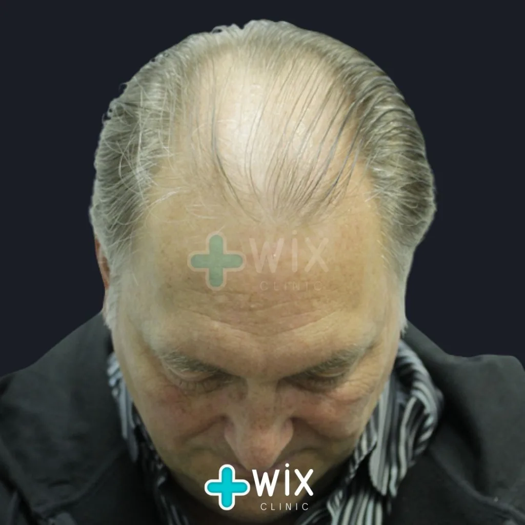 Hair Transplant Before and After