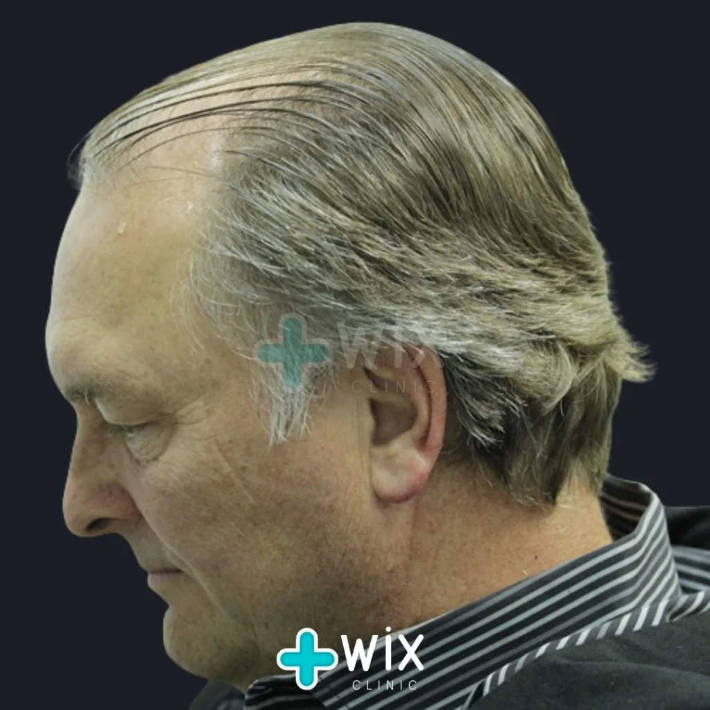 Hair Transplant Before and After