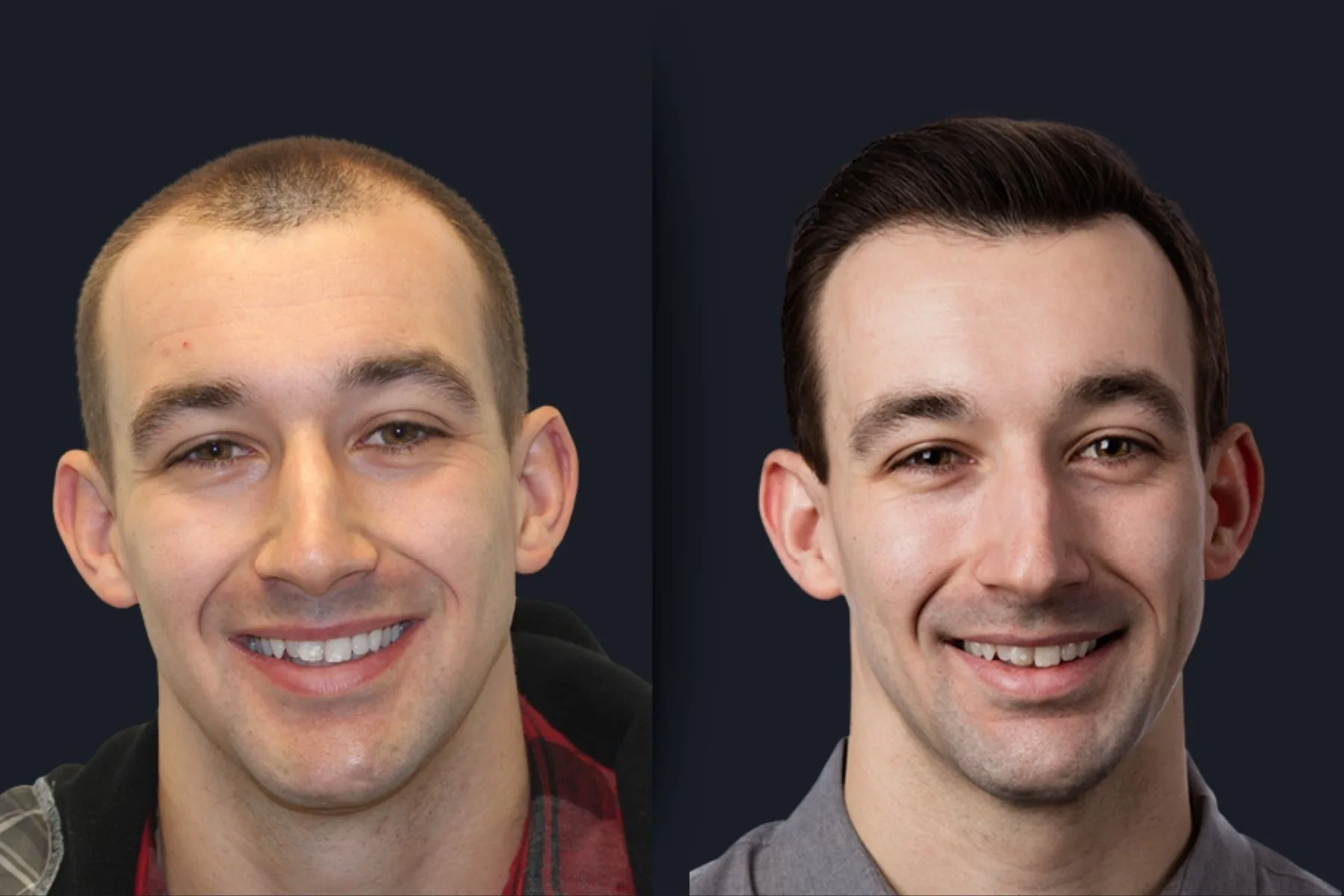 Hair Transplant Before and After