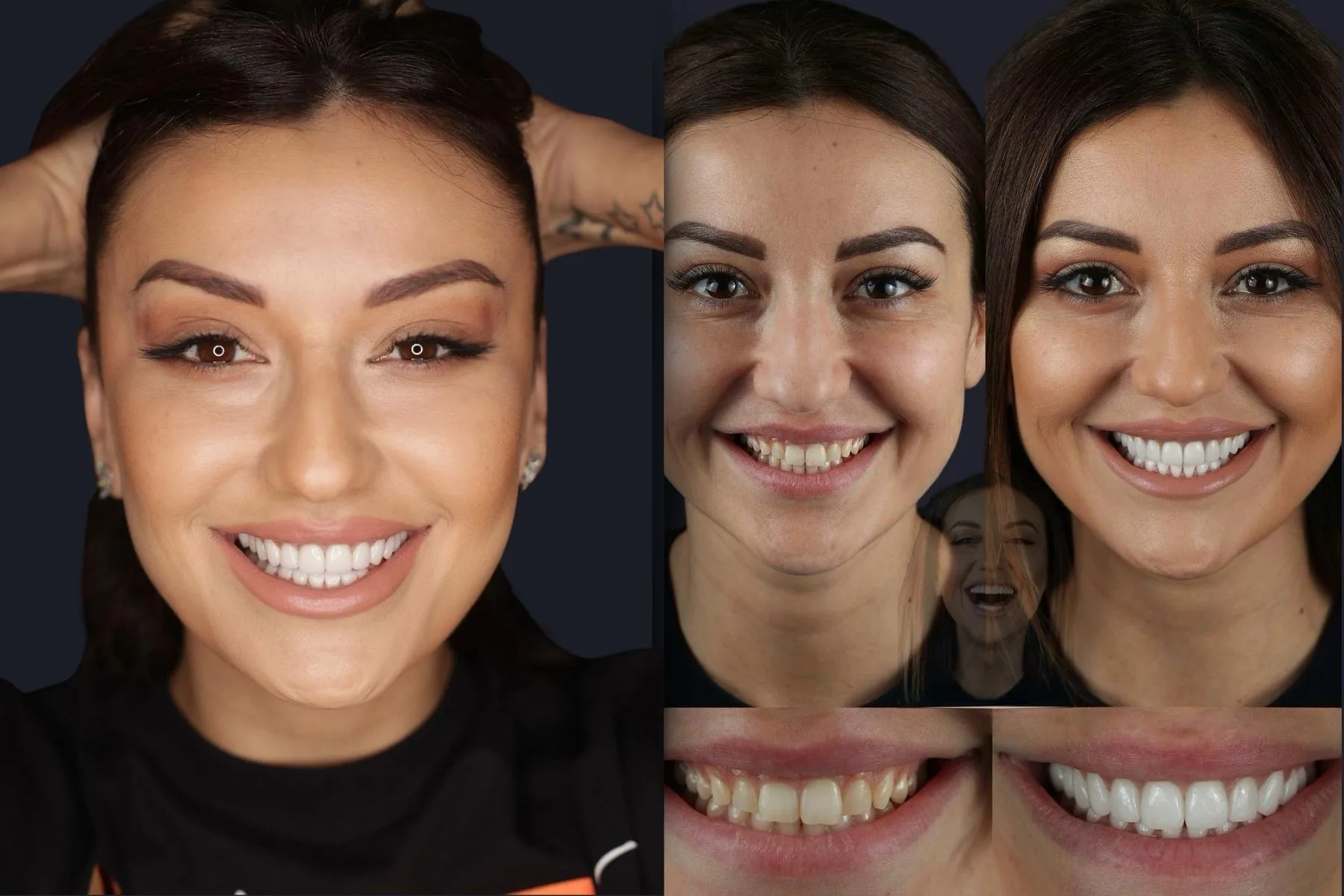 Hollywood Smile Before and After