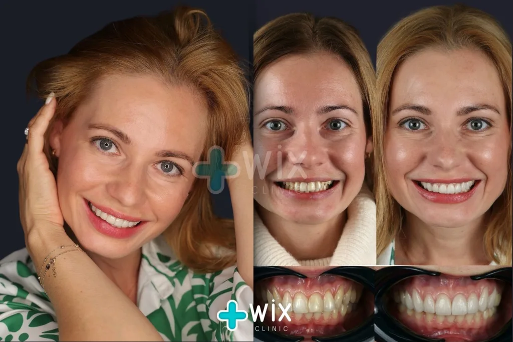 Hollywood Smile Before and After