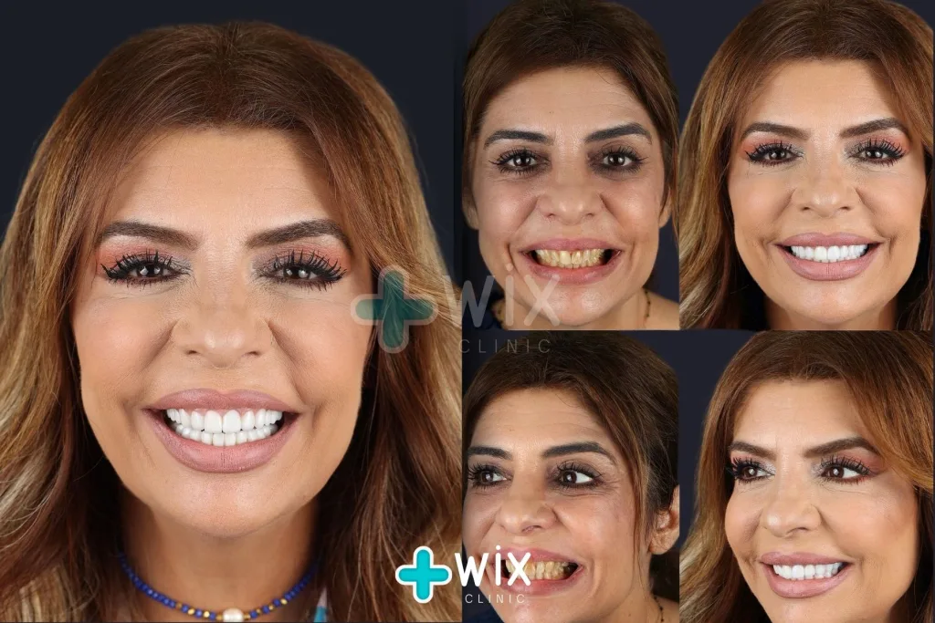 Hollywood Smile Before and After