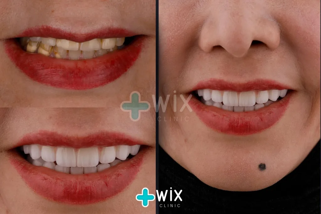 Hollywood Smile Before and After