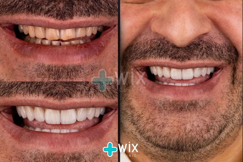 Hollywood Smile Before and After