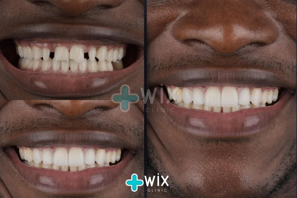 Hollywood Smile Before and After