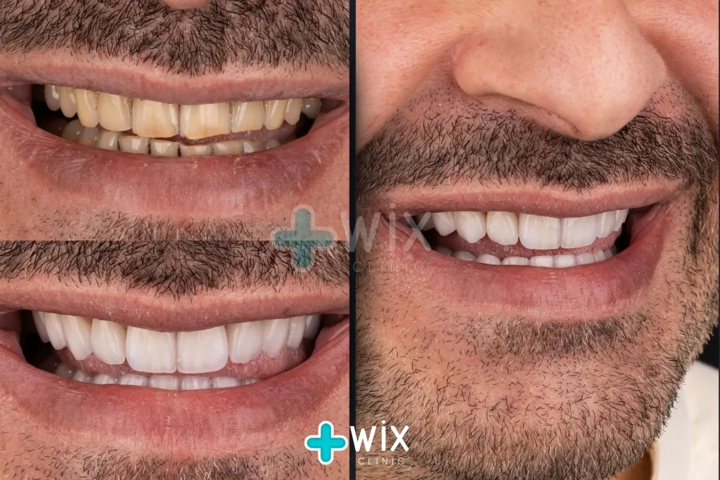 Hollywood Smile Before and After