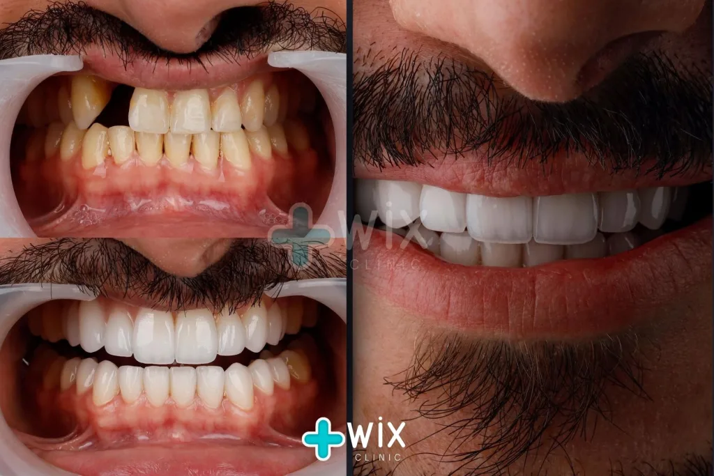 Hollywood Smile Before and After