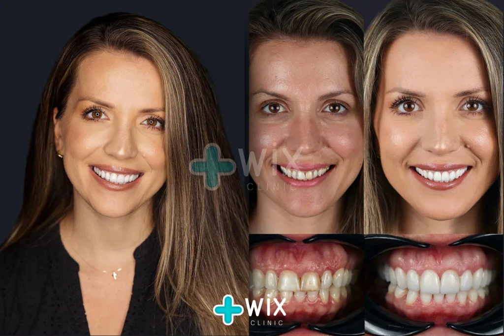 Hollywood Smile Before and After