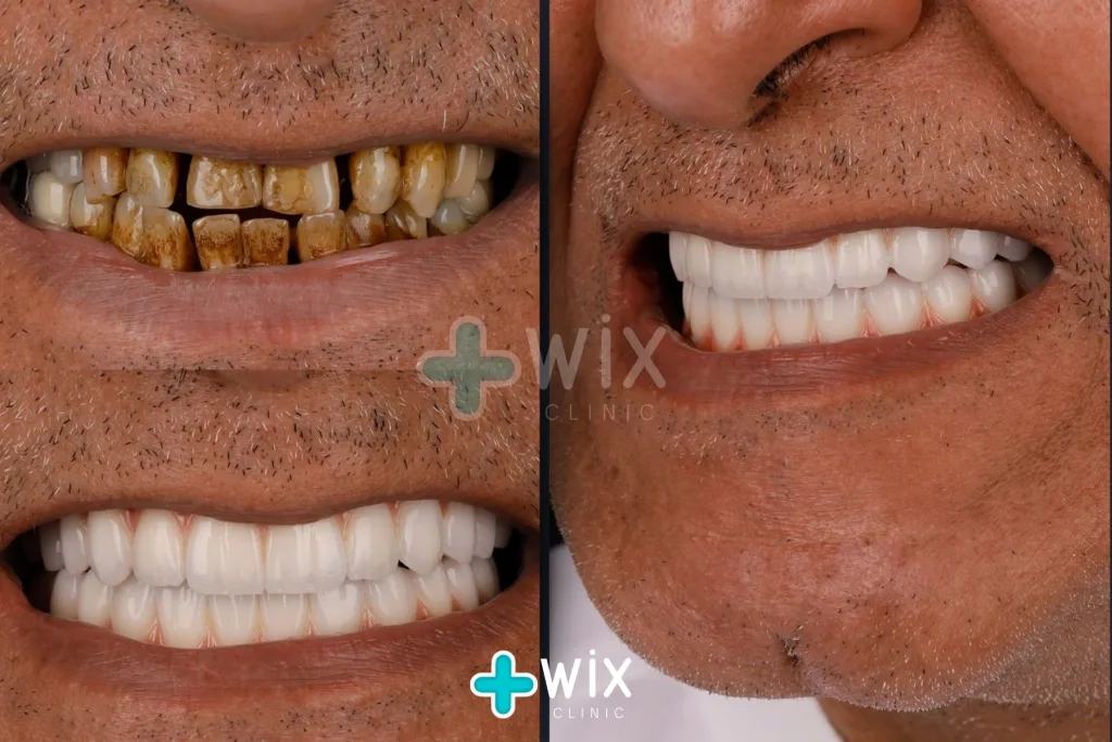 Hollywood Smile Before and After