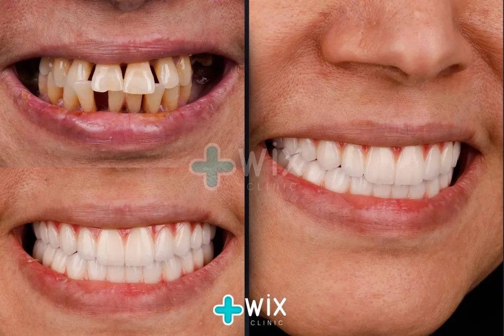 Hollywood Smile Before and After