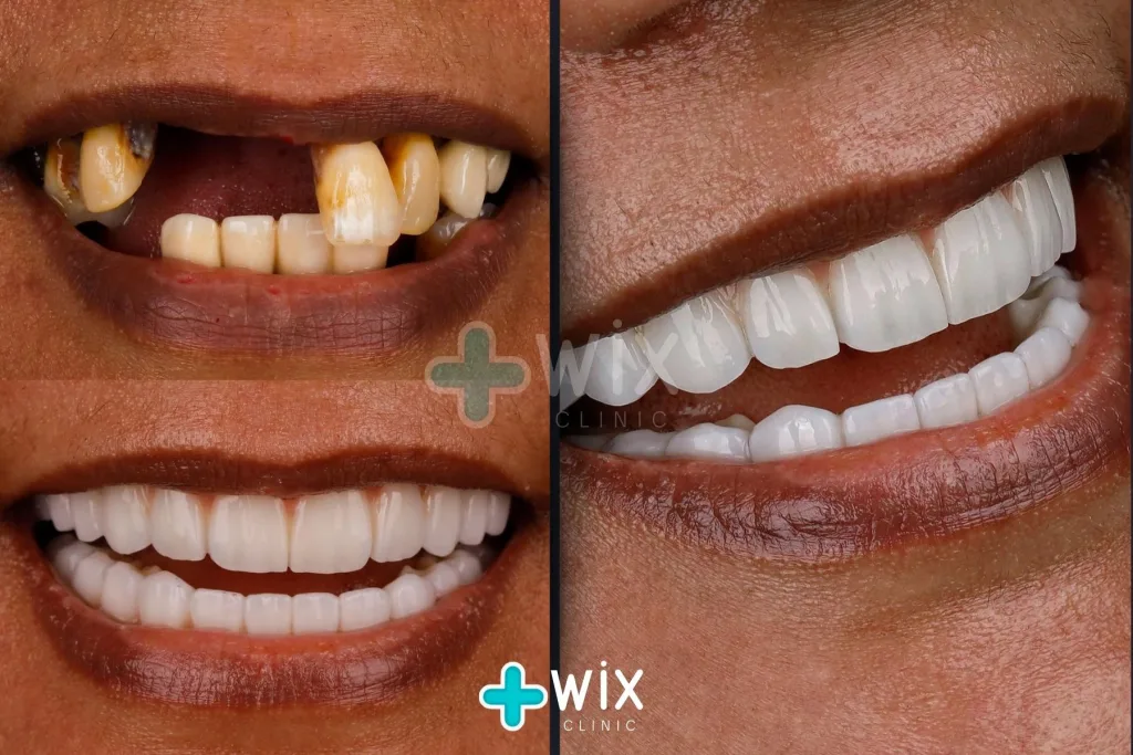 Hollywood Smile Before and After