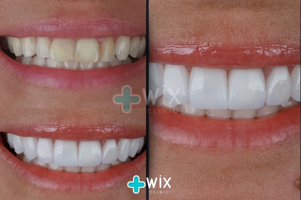 Hollywood Smile Before and After