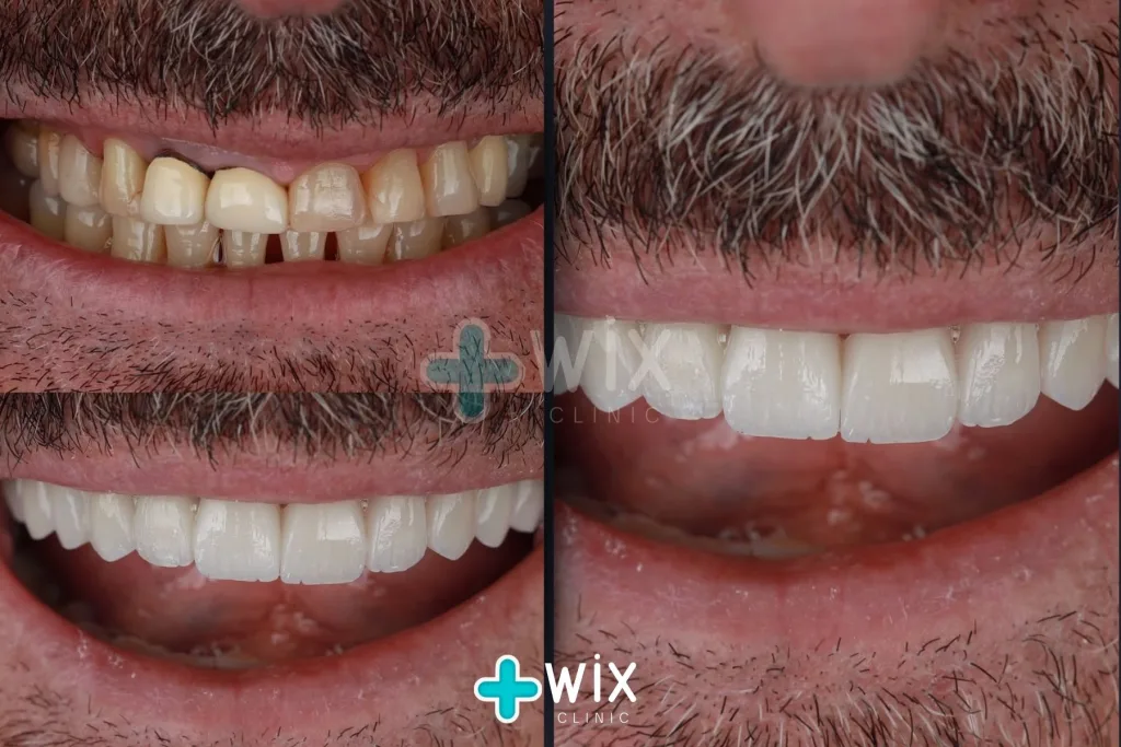 Hollywood Smile Before and After