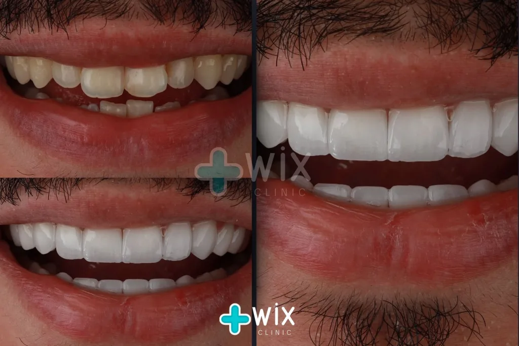 Hollywood Smile Before and After