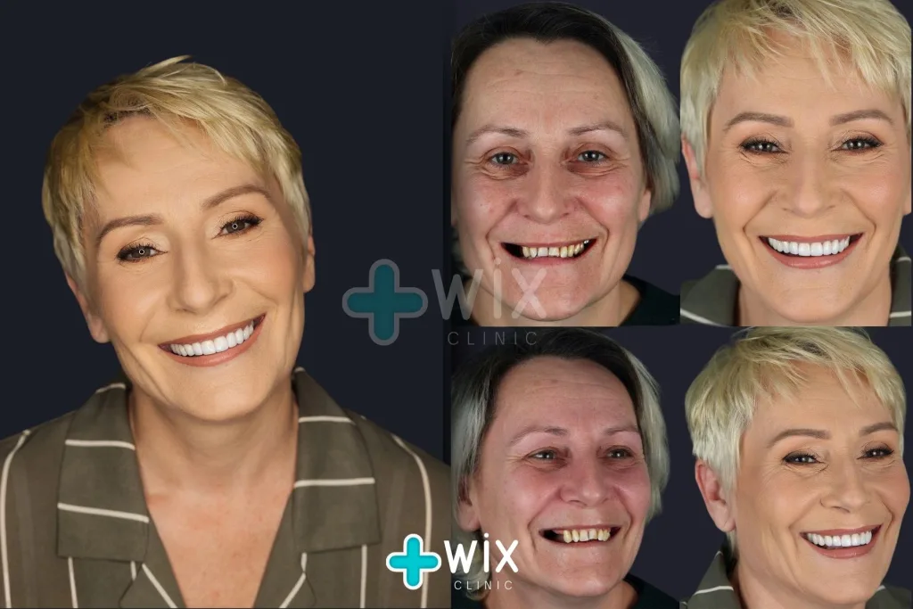 Hollywood Smile Before and After