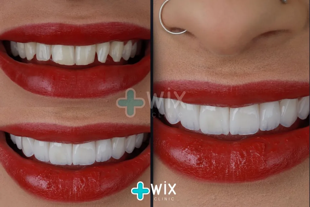 Hollywood Smile Before and After