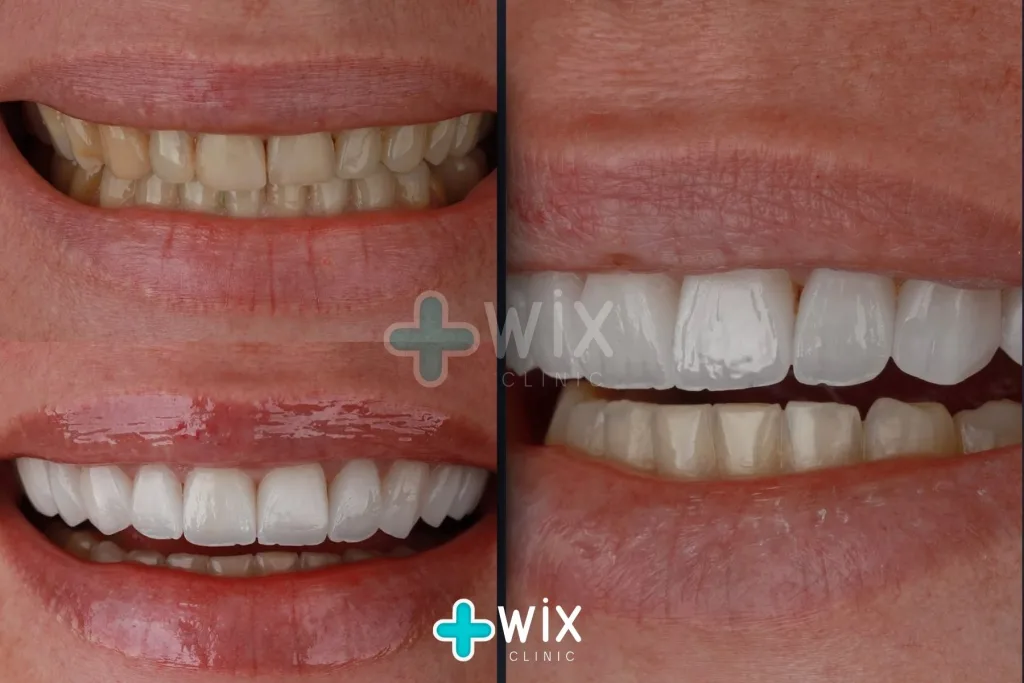 Hollywood Smile Before and After