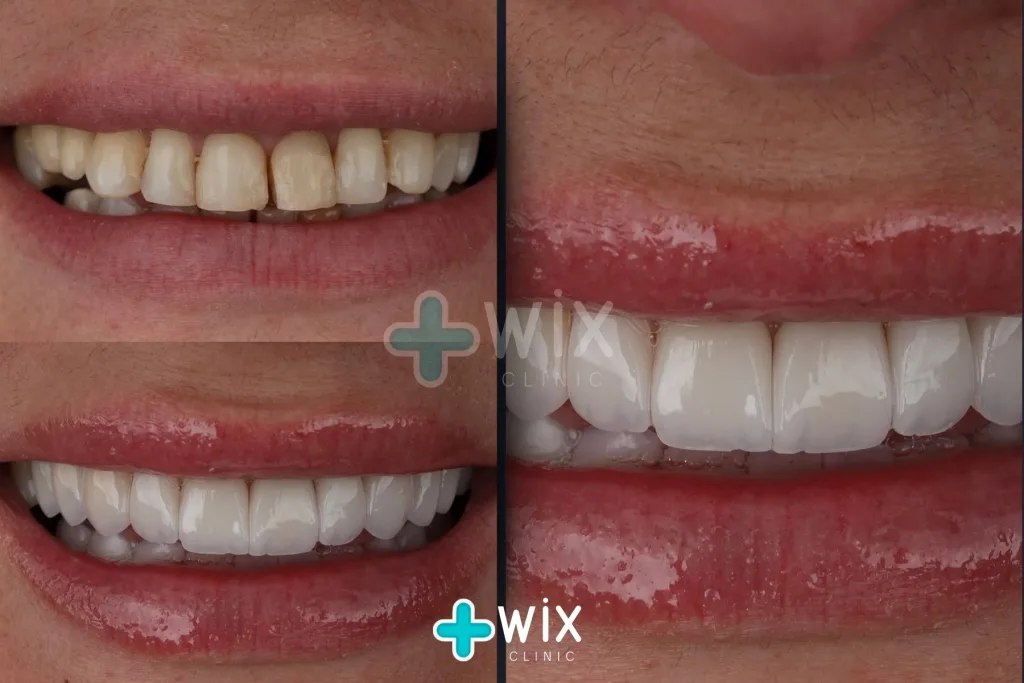 Hollywood Smile Before and After