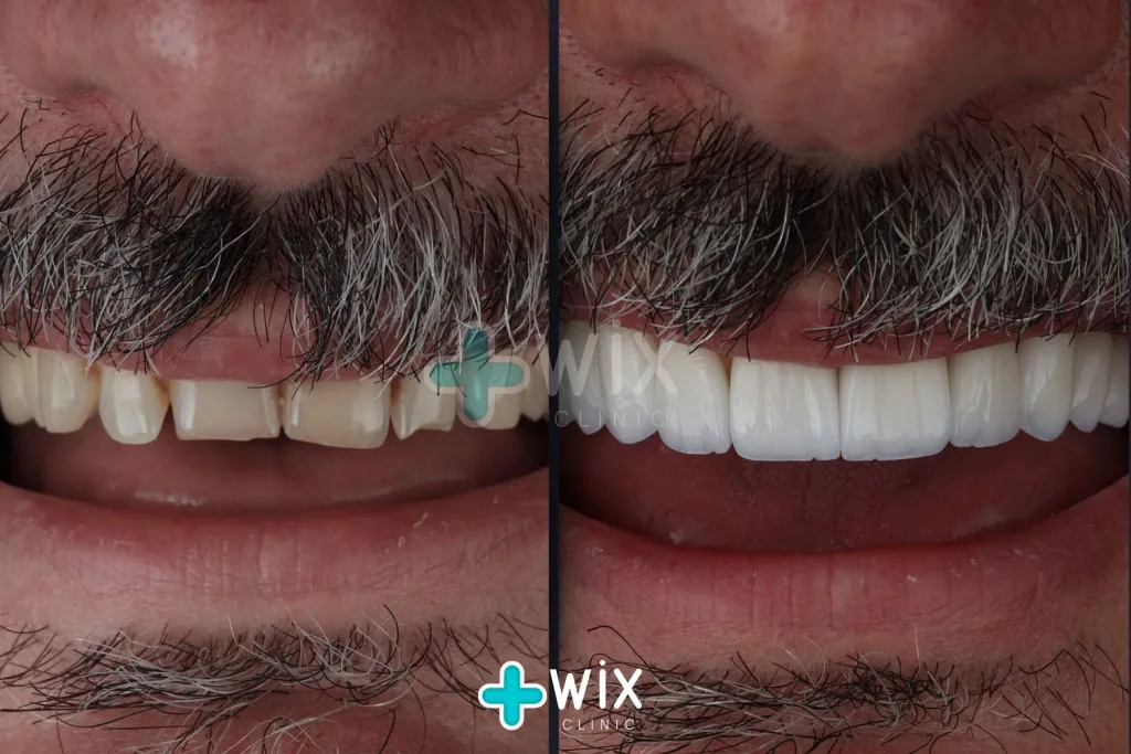 Hollywood Smile Before and After