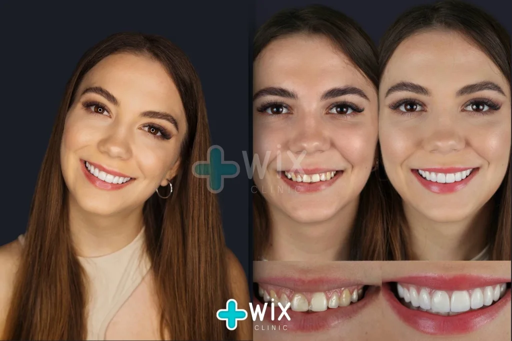 Hollywood Smile Before and After