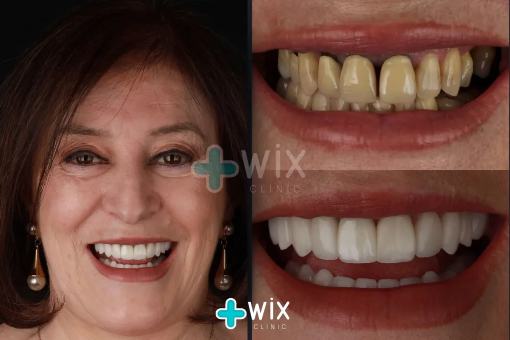 Hollywood Smile Before and After