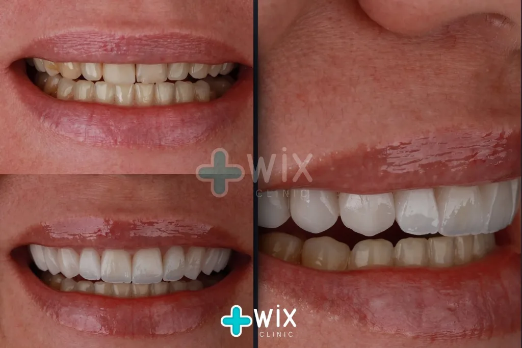 Hollywood Smile Before and After