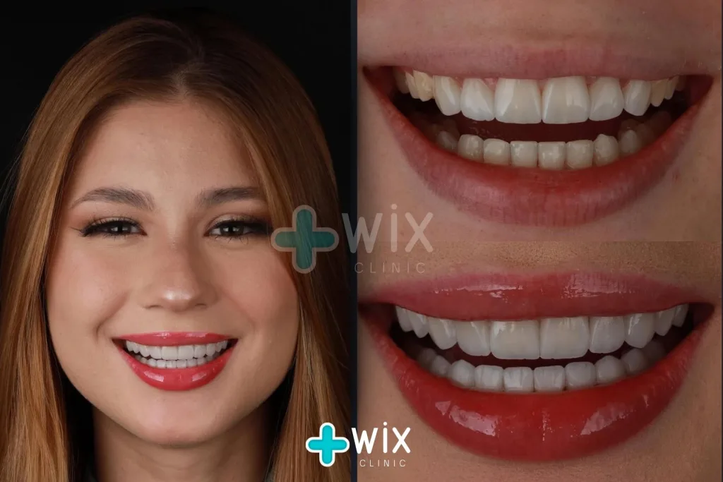 Hollywood Smile Before and After