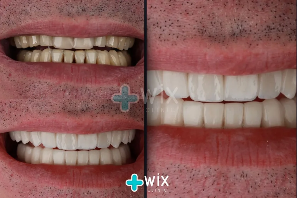 Hollywood Smile Before and After