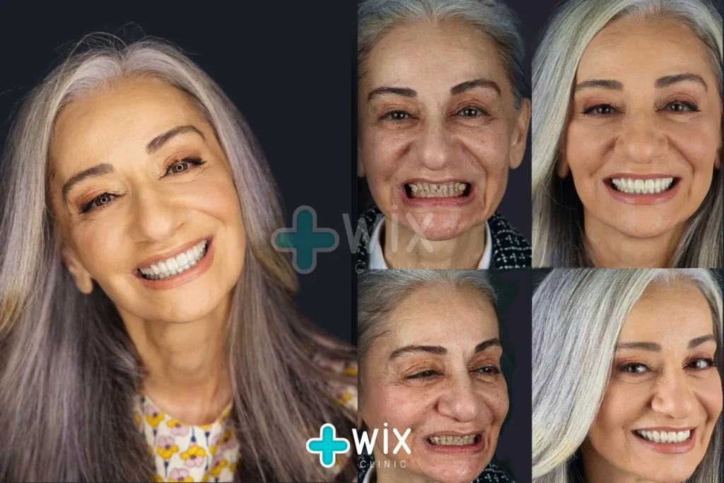 Hollywood Smile Before and After