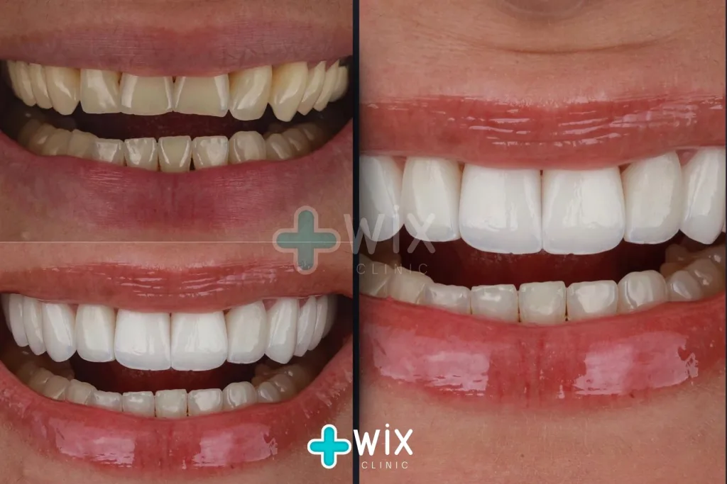 Hollywood Smile Before and After