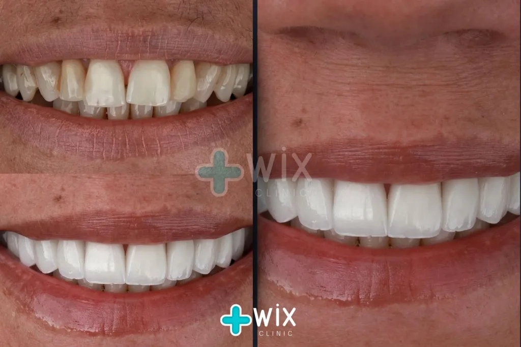 Hollywood Smile Before and After