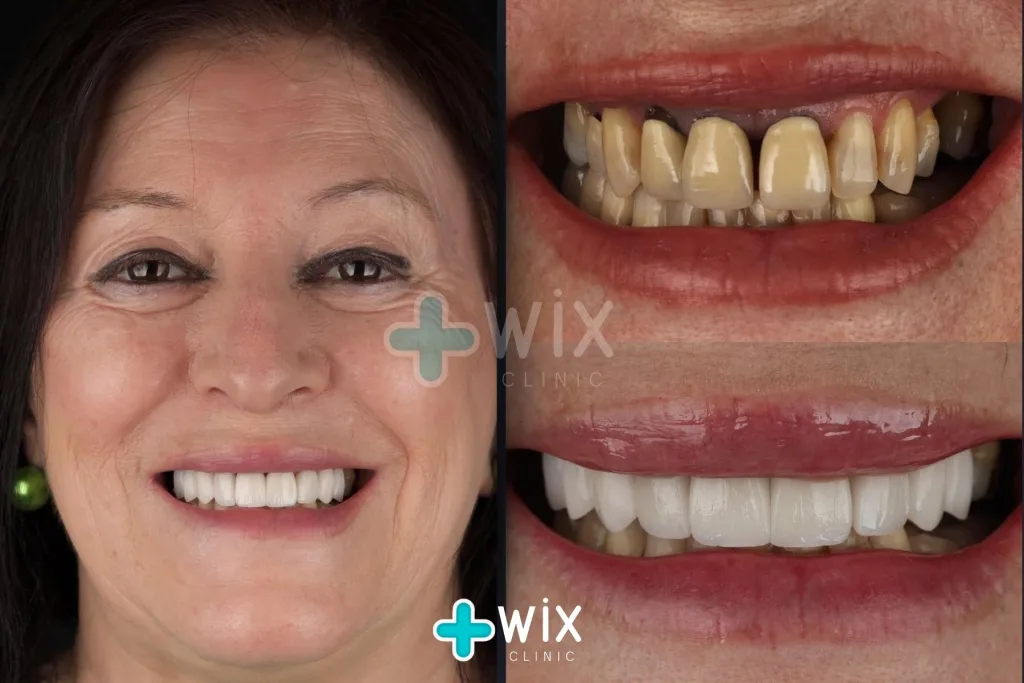 Hollywood Smile Before and After