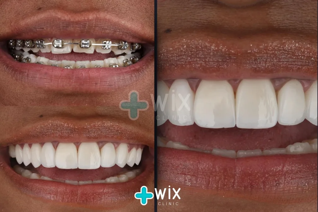 Hollywood Smile Before and After