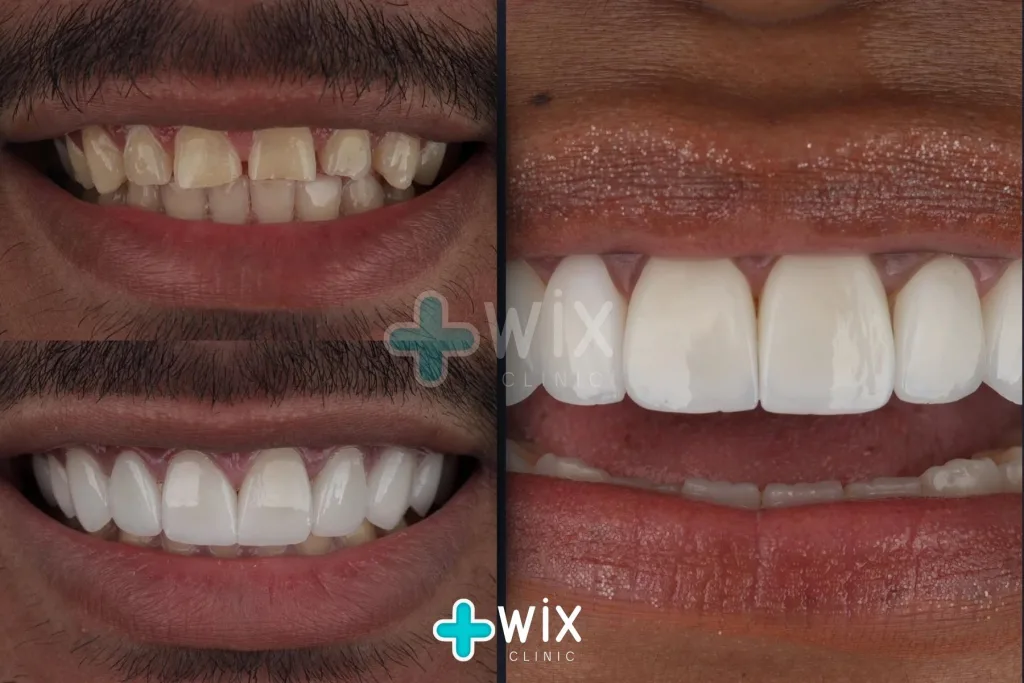 Hollywood Smile Before and After