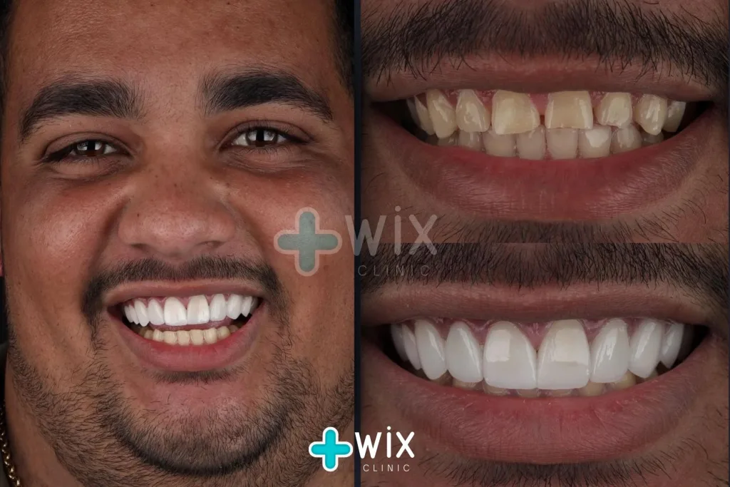 Hollywood Smile Before and After