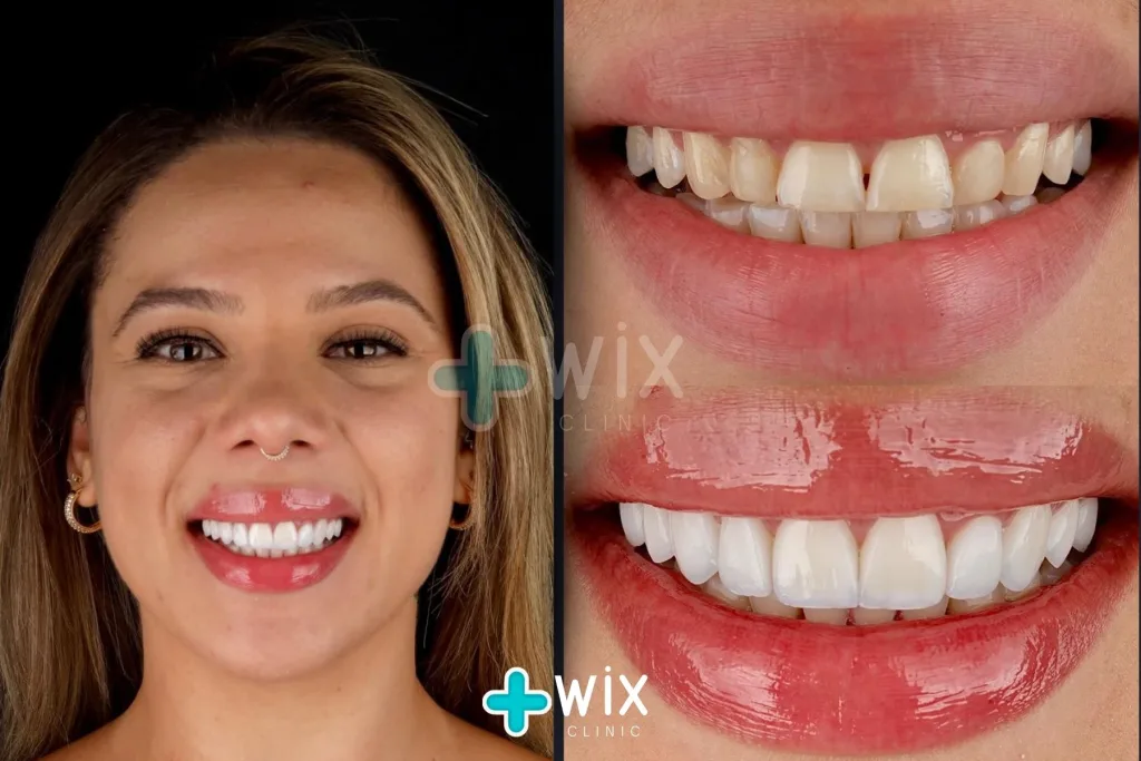 Hollywood Smile Before and After