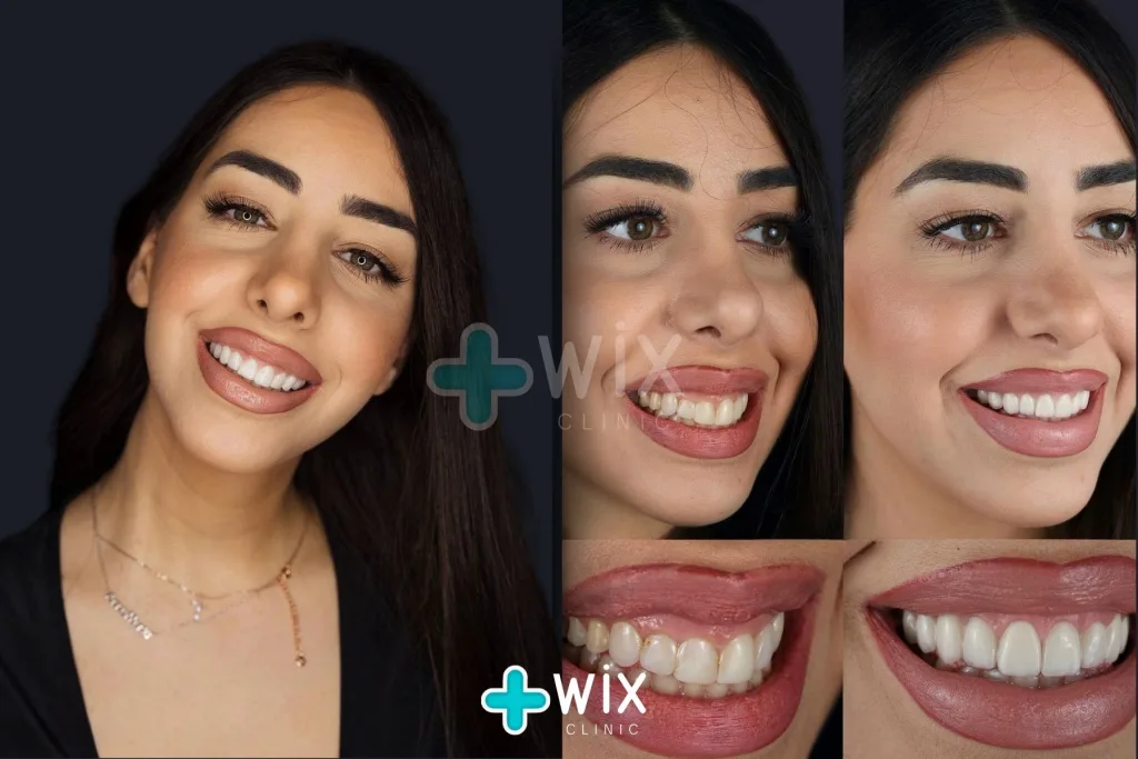 Hollywood Smile Before and After