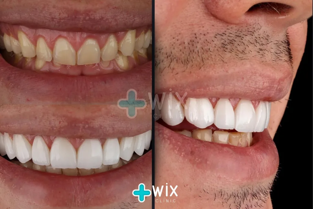 Hollywood Smile Before and After