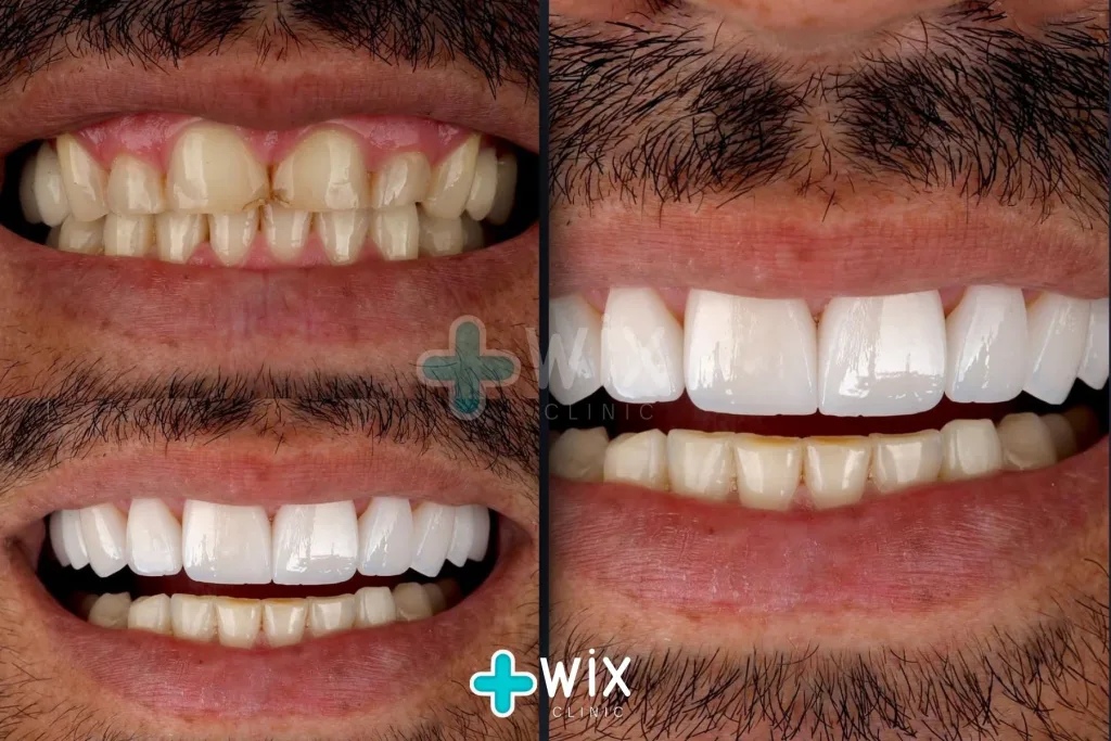 Hollywood Smile Before and After