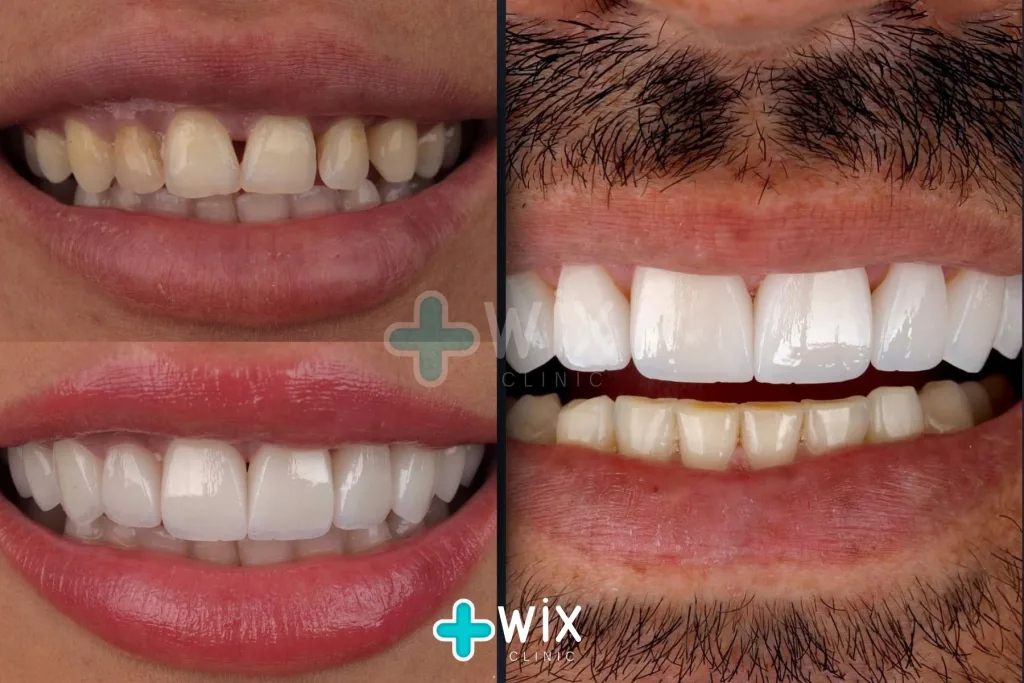 Hollywood Smile Before and After