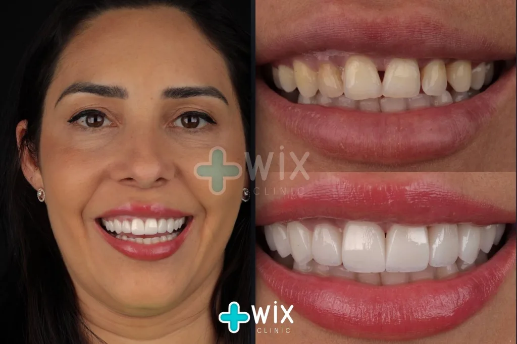 Hollywood Smile Before and After