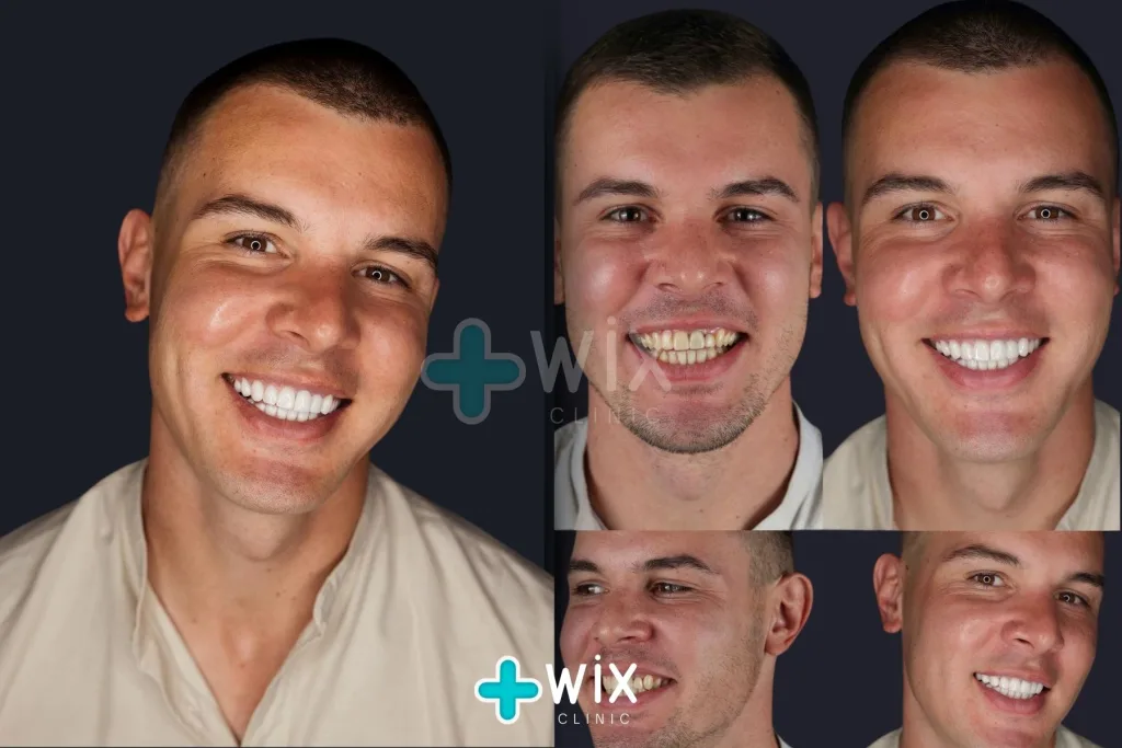 Hollywood Smile Before and After