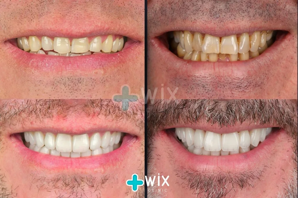 Hollywood Smile Before and After