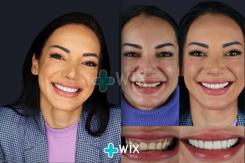 Hollywood Smile Before and After