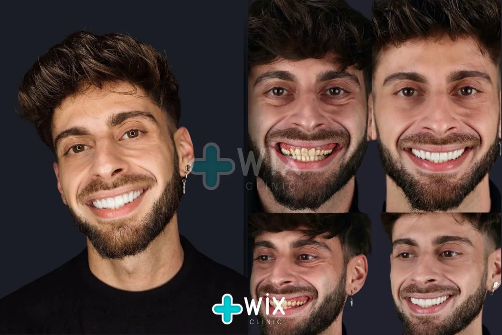 Hollywood Smile Before and After