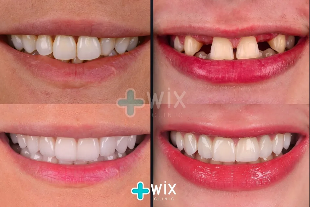 Hollywood Smile Before and After