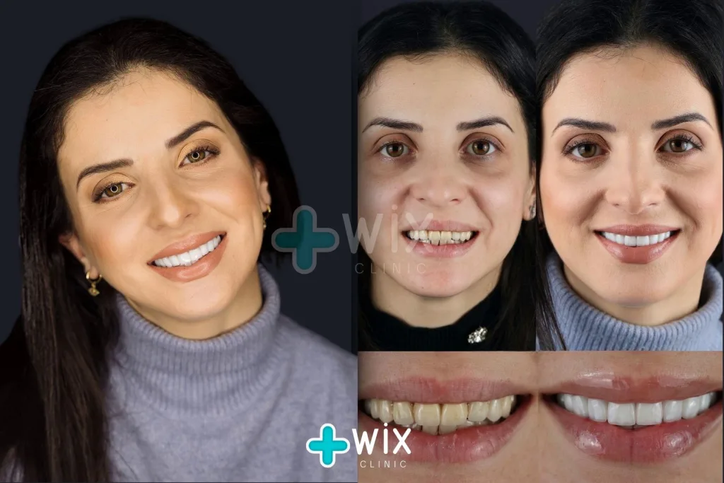 Hollywood Smile Before and After