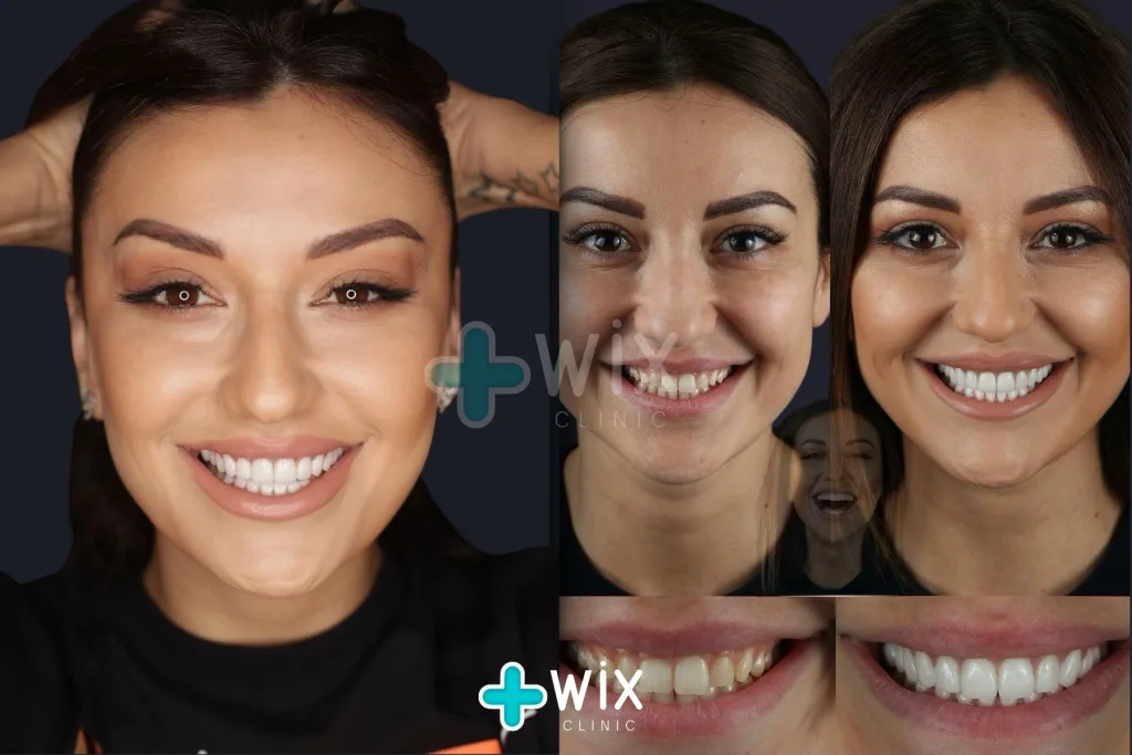 Hollywood Smile Before and After