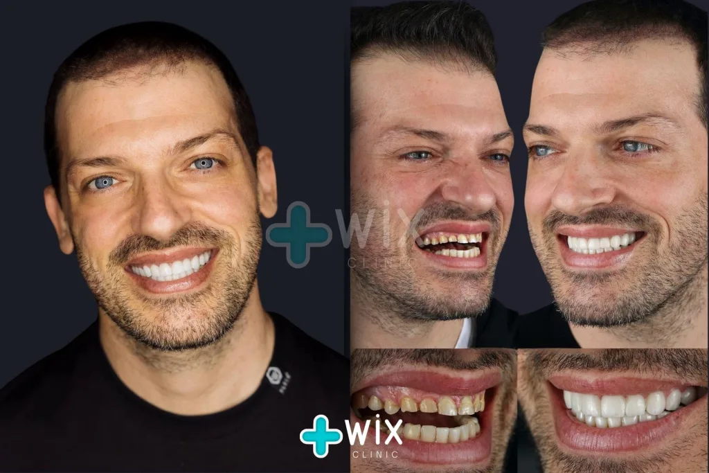 Hollywood Smile Before and After