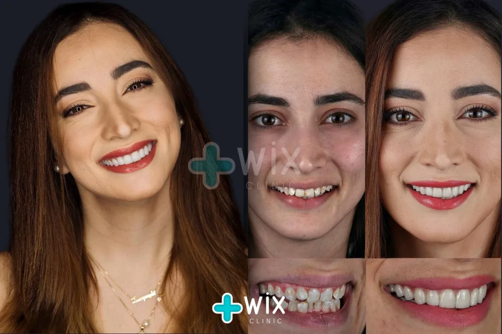 Hollywood Smile Before and After